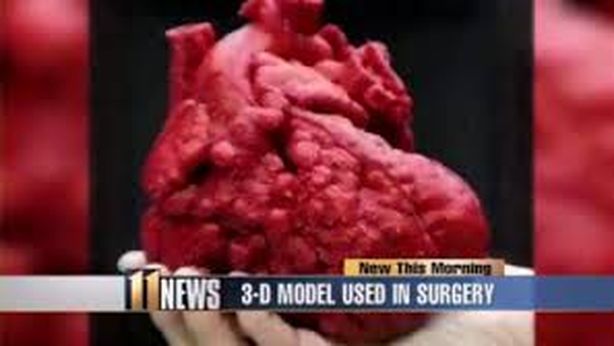 Salvato un bambino grazie a un cuore stampato in 3D
