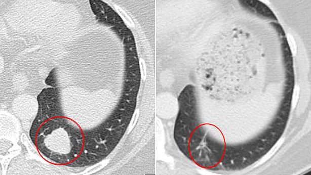 Rivoluzione nella cura del cancro: test positivi su nuovi farmaci
