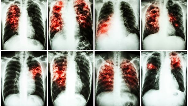 Tubercolosi: entro il 2050 ucciderà 75 milioni di persone e costerà $16.700 miliardi