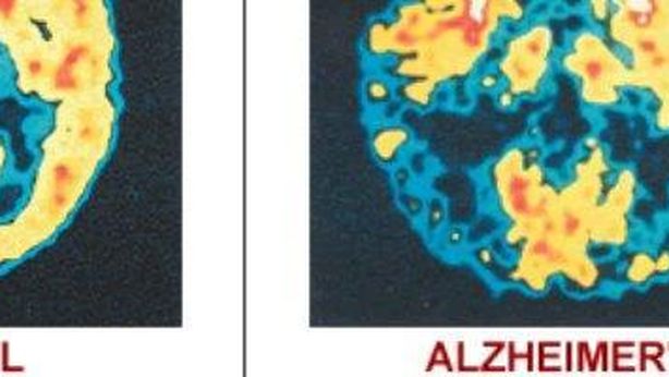 Alzheimer e Parkinson: super computer ne studierà le cure